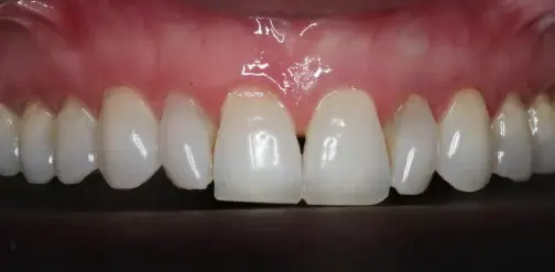 The same gum line after Pinhole Gum Rejuvenation