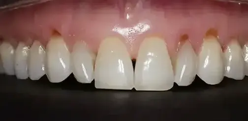Gum recession before treatment