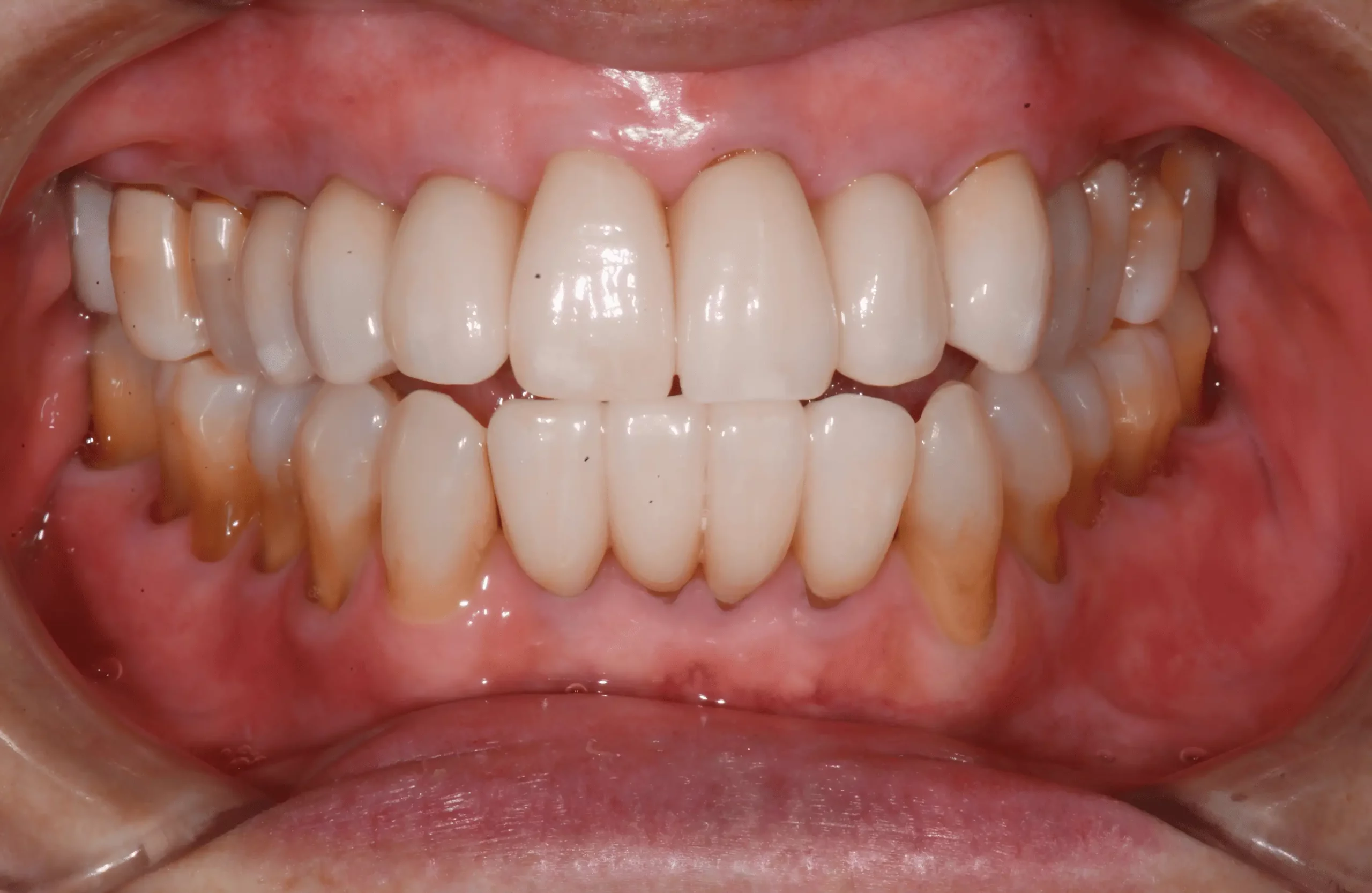 Eliza T. three years after Pinhole Gum Rejuvenation
