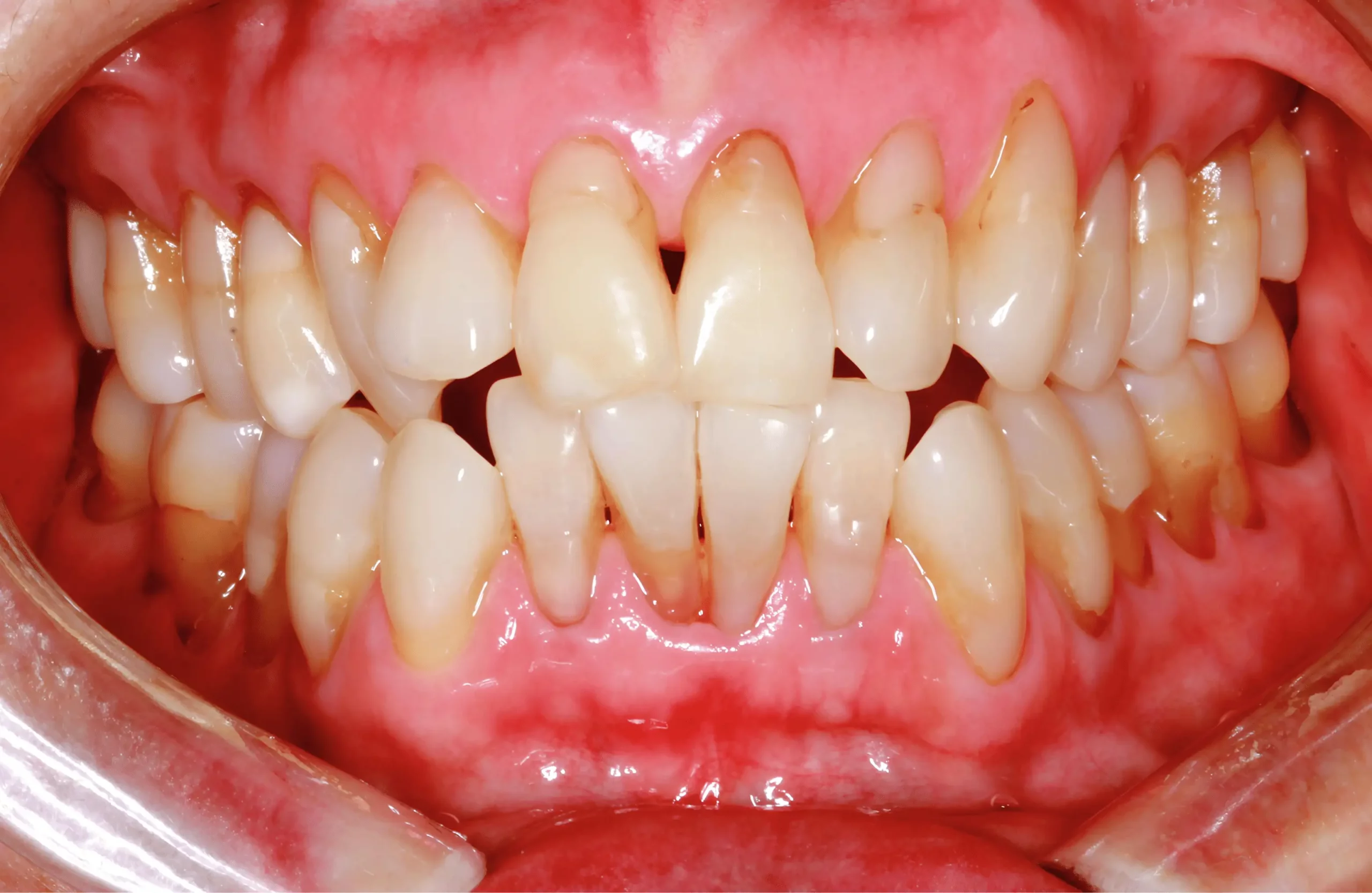Eliza T. before Pinhole Gum Rejuvenation