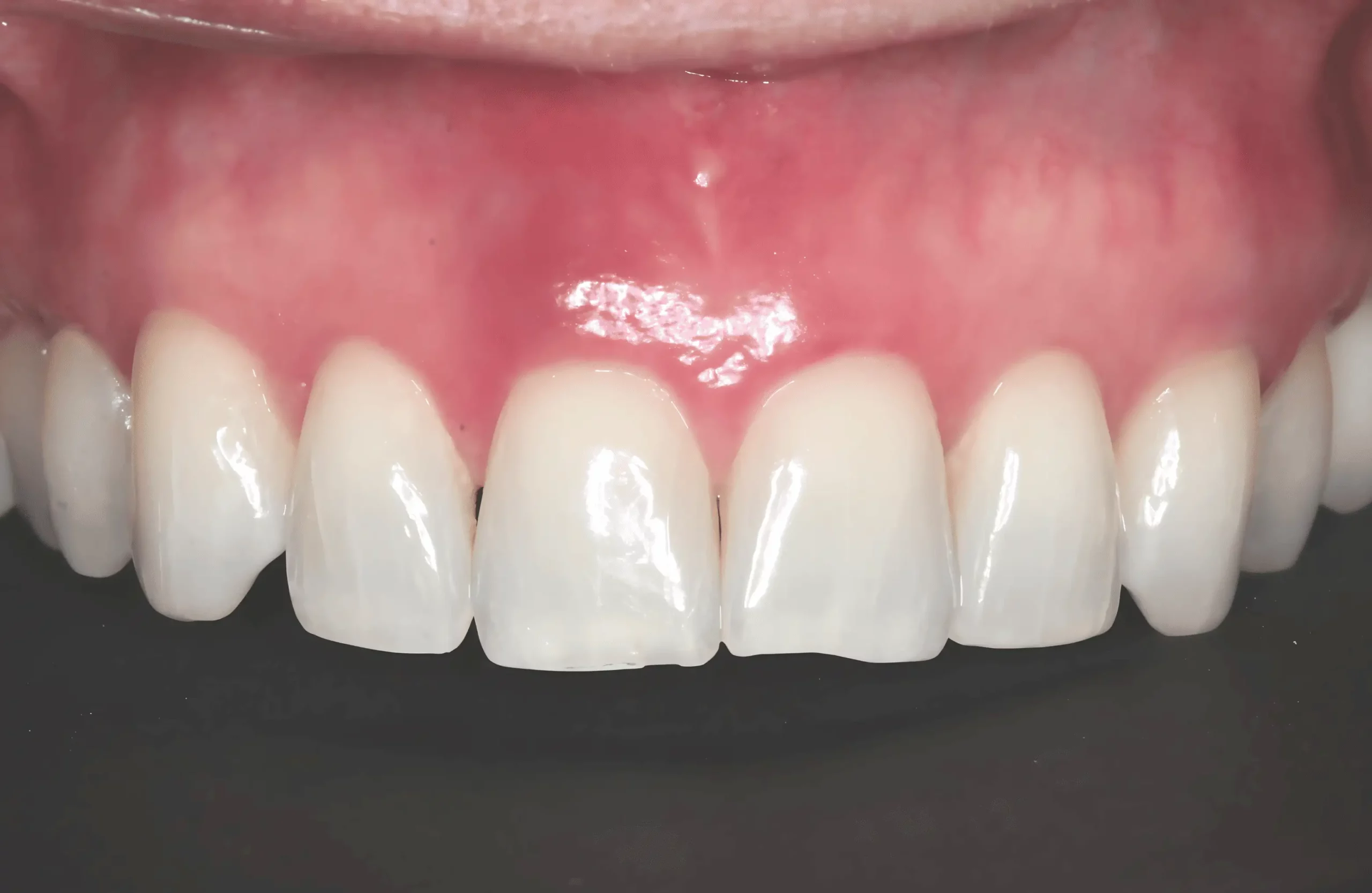 Rocio K. ten years after Pinhole Gum Rejuvenation
