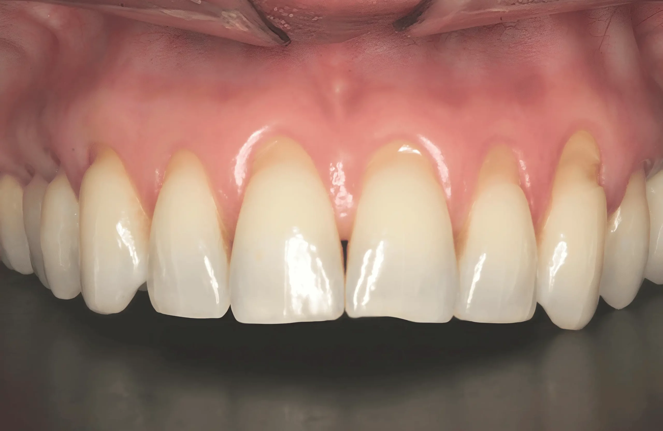 Rocio K. before Pinhole Gum Rejuvenation