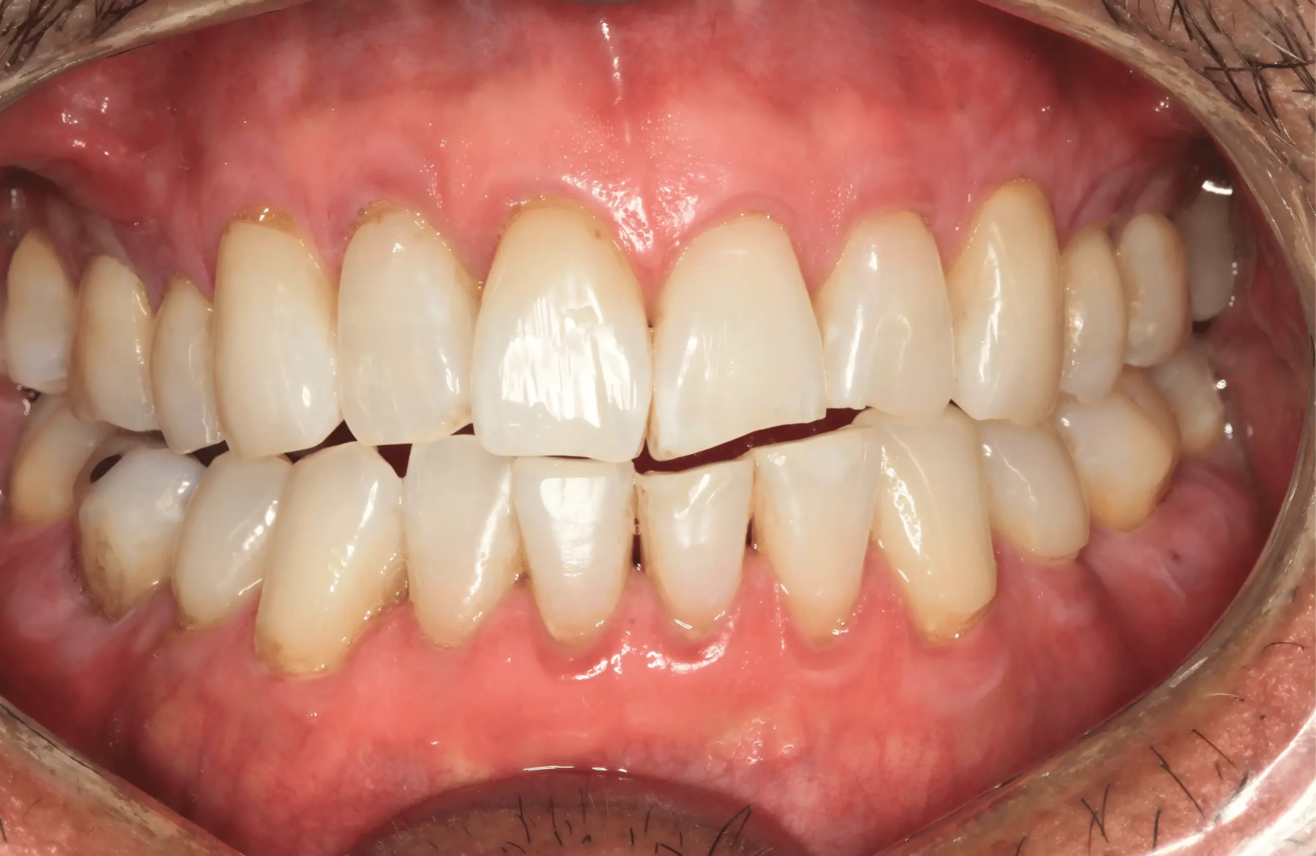 Rodney K. six years after Pinhole Gum Rejuvenation