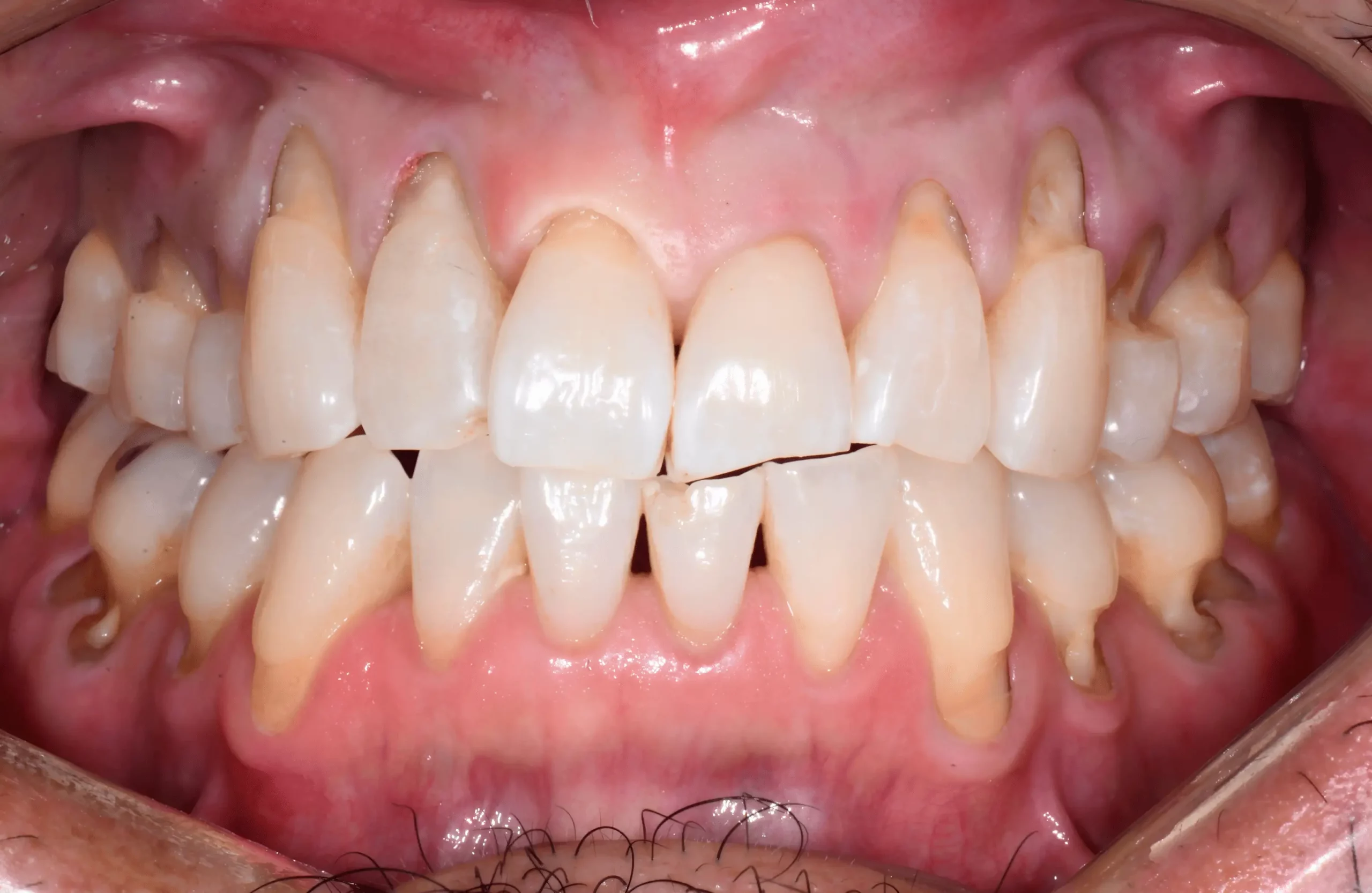 Rodney K. before Pinhole Gum Rejuvenation