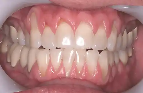 Gum line before Pinhole Gum Rejuvenation, showing recession