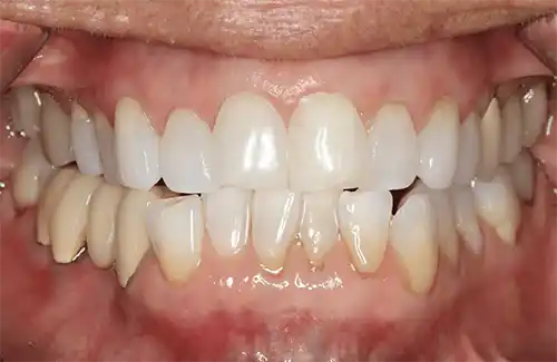 The same gum line 14 years after Pinhole Gum Rejuvenation