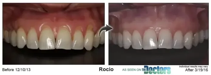 Rocio — gum line before Pinhole® treatment in December 2013 and after, in March 2016