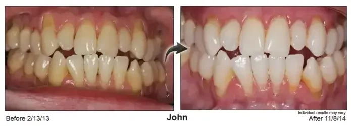 John — gum line before Pinhole® treatment in February 2013 and after, in November 2014
