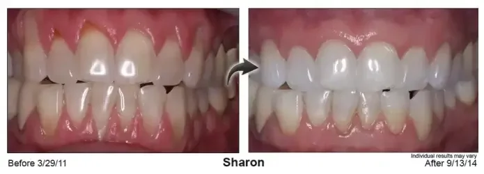 Sharon — gum line before Pinhole® treatment in March 2011 and after, in September 2014