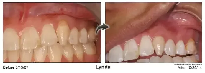 Lynda — gum line before Pinhole® treatment in March 2007 and after, in October 2014