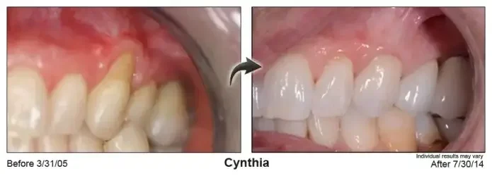 Cynthia — gum line before Pinhole® treatment in March 2005 and after, in July 2014